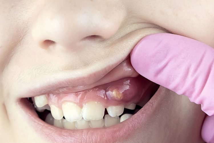 انتفاخ اللثة فوق الضرس