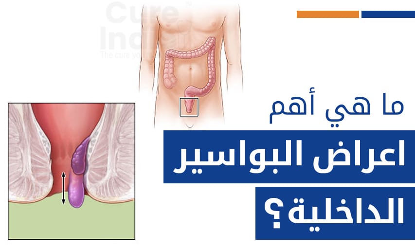 ما هي أعراض البواسير الداخلية؟