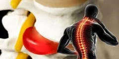 الصلب المشقوق المستتر