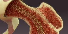 متلازمة خلل التنسج النقوي