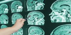 أعراض نزيف الدماغ عند الأطفال