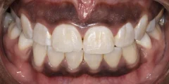 أسباب سواد اللثة وافضل طرق العلاج