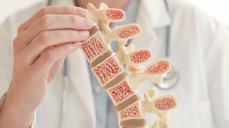 أعراض هشاشة العظام