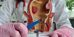 علاج البواسير الخارجية المنتفخة