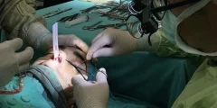 ثقب الحاجز الأنفي: الأسباب والأعراض والعلاج
