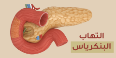 أعراض التهاب البنكرياس