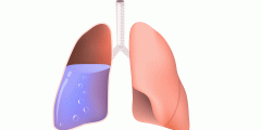 أسباب تجمع سوائل في الرئة