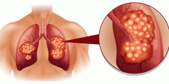 سرطان الرئة عند الأطفال