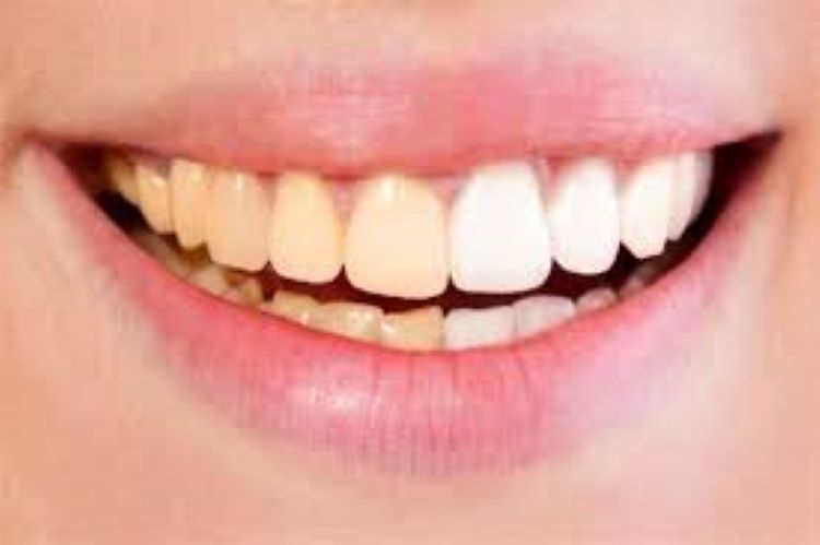 أسباب اصفرار الأسنان