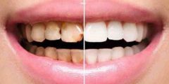 تغير لون الأسنان: الأسباب وكيفية علاجه و طرق الوقاية منها