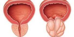 علاج احتباس البول بسبب البروستاتا
