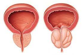 علاج احتباس البول بسبب البروستاتا