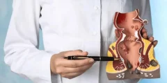 علاج الناسور بدون جراحة