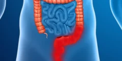 نوبات القولون التقرحي