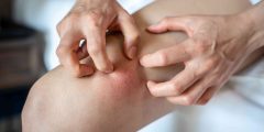 حروق الفخذ: دليل الإسعافات الأولية