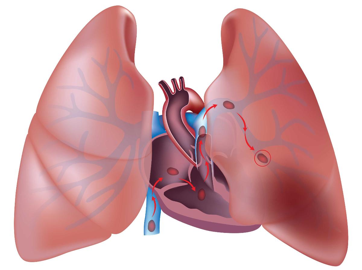 تخثر الدم في الرئة