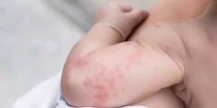 حساسية الجلوتين عند الأطفال