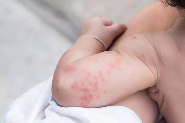 حساسية الجلوتين عند الأطفال