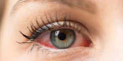 حساسية العين