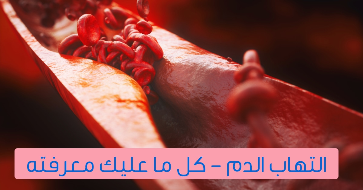 أسباب التهاب الدم