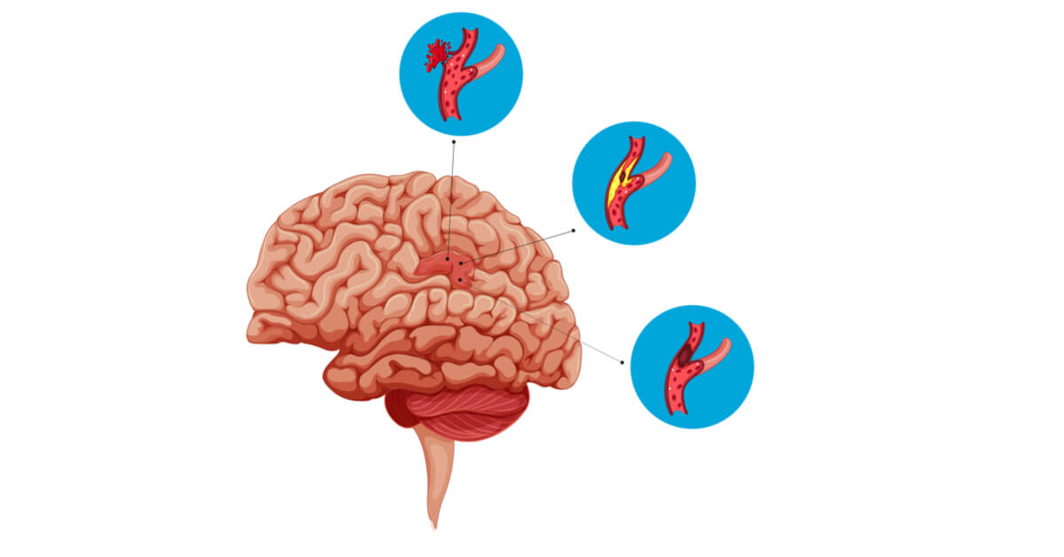 تمدد الأوعية الدموية في الدماغ