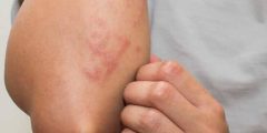 علاج حساسية القمح