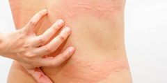 أسباب وأعراض حساسية الأرتكاريا وعلاجها