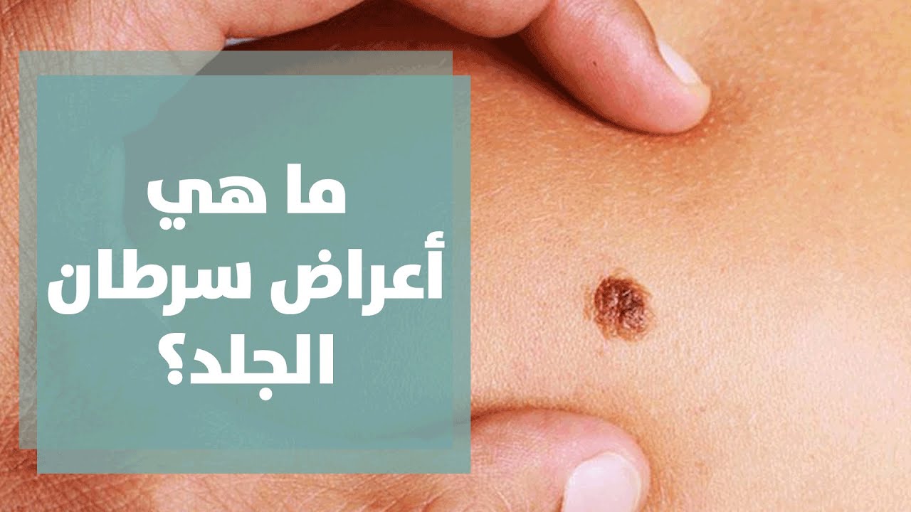تشخيص سرطان الجلد