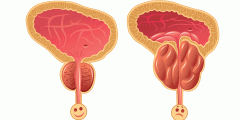 تضخم البروستات وسرطان البروستات