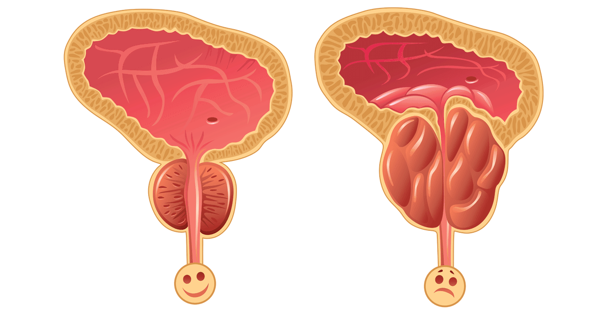 تضخم البروستات وسرطان البروستات