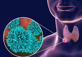 نتشار سرطان الغدة الدرقية