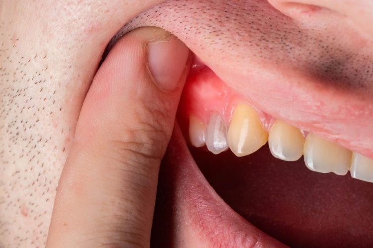 التهاب اللثة: الأعراض والأسباب وطرق العلاج