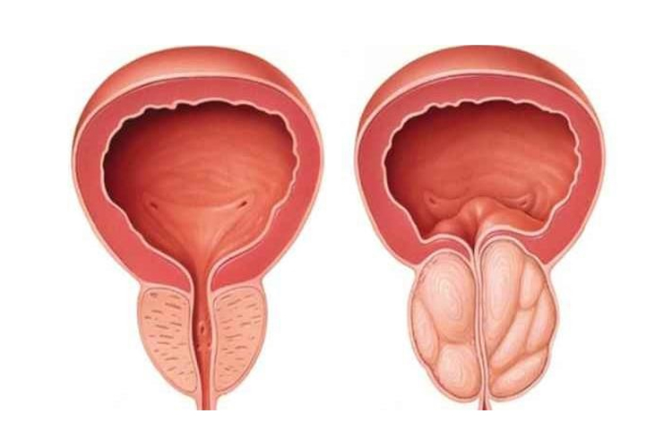 علاج التهاب البروستاتا بالطب البديل