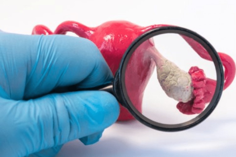 علاج تكيسات المبيض بالاعشاب​