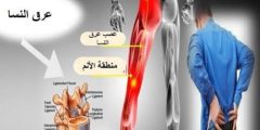 علاج عرق النسا في الطب البديل