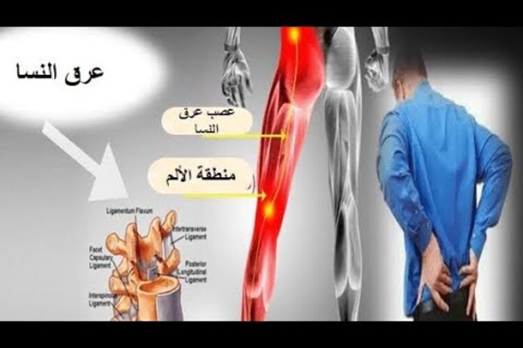 علاج عرق النسا في الطب البديل